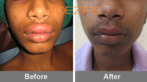 abhishek lip reduction surgery Delhi, Pune, Bangalore