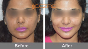 Cosmetic Dermal Filler Delhi, Pune, Bangalore, Gurgaon