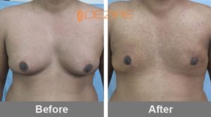breast reduction surgery for males