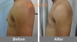 male chest reduction