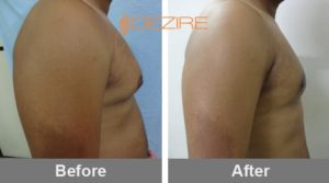 breast reduction male