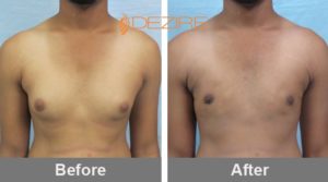 male chest reduction surgery
