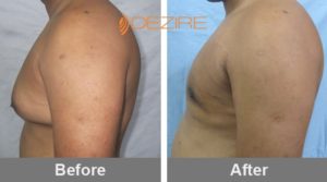 male breasts reduction