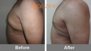 male breast reduction without surgery